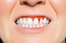 What Is Gum Disease?